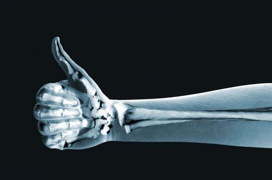 X-ışını parmak eklemlerindeki ağrının teşhisine yardımcı olabilir